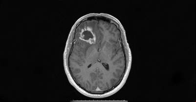 Medicamento de hidrogel cura câncer cerebral em rato
